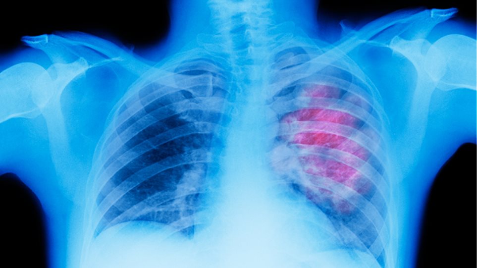 Σημαντική η ένταξη ασθενών με καρκίνο πνεύμονα σε κλινικές μελέτες