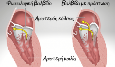 Μελέτη RESHAPE-HF2: Αναδεικνύει την ελληνική συμβολή στη διαδερμική θεραπεία μιτροειδούς