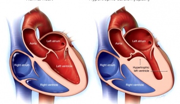 «Μήπως είναι υπερτροφική μυοκαρδιοπάθεια;»