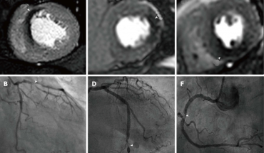 Stress Perfusion MRI: Η εξέταση που ανιχνεύει με ακρίβεια καρδιακές παθήσεις