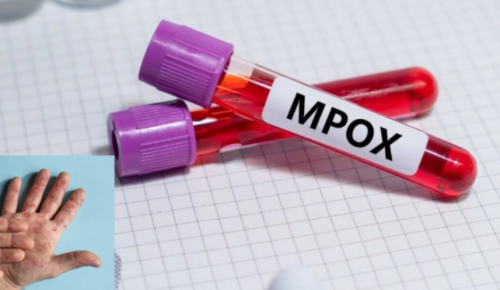 Mpox ή ευλογιά των πιθήκων: Εντοπίστηκαν κρούσματα του νέου τύπου στη Μεγάλη Βρετανία